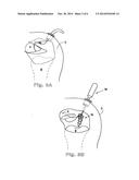 Suture Anchor Device, Kit and Method diagram and image