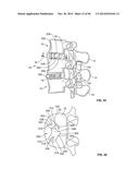 INTERVERTEBRAL IMPLANT DEVICES AND METHODS FOR INSERTION THEREOF diagram and image