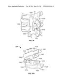 INTERVERTEBRAL IMPLANT DEVICES AND METHODS FOR INSERTION THEREOF diagram and image