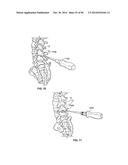 INTERVERTEBRAL IMPLANT DEVICES AND METHODS FOR INSERTION THEREOF diagram and image