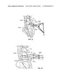 INTERVERTEBRAL IMPLANT DEVICES AND METHODS FOR INSERTION THEREOF diagram and image