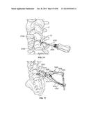 INTERVERTEBRAL IMPLANT DEVICES AND METHODS FOR INSERTION THEREOF diagram and image