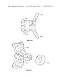 INTERVERTEBRAL IMPLANT DEVICES AND METHODS FOR INSERTION THEREOF diagram and image