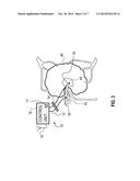 ELECTROOSMOTIC TISSUE TREATMENT diagram and image