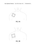 DEVICE AND METHOD FOR SELF-POSITIONING OF A STIMULATION DEVICE TO ACTIVATE     BROWN ADIPOSE TISSUE DEPOT IN SUPRACLAVICULAR FOSSA REGION diagram and image