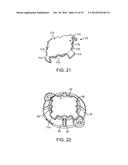 CRANIAL BURR HOLE PLUG WITH ANTI-SKEWING CLAMPING MECHANISM diagram and image