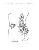 MINIMALLY INVASIVE METHODS FOR IMPLANTING A SACRAL STIMULATION LEAD diagram and image