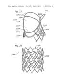 LOW-PROFILE HEART VALVE AND DELIVERY SYSTEM diagram and image