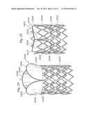 LOW-PROFILE HEART VALVE AND DELIVERY SYSTEM diagram and image