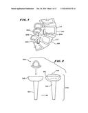 FACET ARTHROPLASTY DEVICES AND METHODS diagram and image