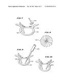 FACET ARTHROPLASTY DEVICES AND METHODS diagram and image