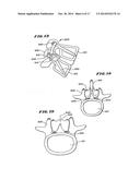 FACET ARTHROPLASTY DEVICES AND METHODS diagram and image