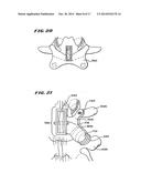 FACET ARTHROPLASTY DEVICES AND METHODS diagram and image