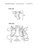 FACET ARTHROPLASTY DEVICES AND METHODS diagram and image