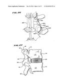 FACET ARTHROPLASTY DEVICES AND METHODS diagram and image