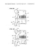 FACET ARTHROPLASTY DEVICES AND METHODS diagram and image