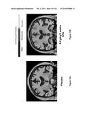 TREATMENT OF ALZHEIMER S DISEASE SUBPOPULATIONS WITH POOLED IMMUNOGLOBULIN     G diagram and image