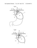 METHODS AND INSTRUMENTS FOR TREATING GERD AND HAITAL HERNIA diagram and image