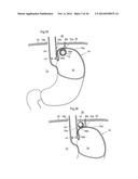 METHODS AND INSTRUMENTS FOR TREATING GERD AND HAITAL HERNIA diagram and image