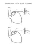 METHODS AND INSTRUMENTS FOR TREATING GERD AND HAITAL HERNIA diagram and image