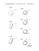 METHODS AND INSTRUMENTS FOR TREATING GERD AND HAITAL HERNIA diagram and image