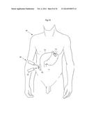 METHODS AND INSTRUMENTS FOR TREATING GERD AND HAITAL HERNIA diagram and image