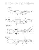 METHODS AND INSTRUMENTS FOR TREATING GERD AND HAITAL HERNIA diagram and image