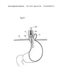 METHODS AND INSTRUMENTS FOR TREATING GERD AND HAITAL HERNIA diagram and image