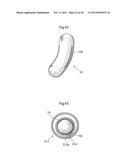 METHODS AND INSTRUMENTS FOR TREATING GERD AND HAITAL HERNIA diagram and image