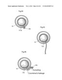 METHODS AND INSTRUMENTS FOR TREATING GERD AND HAITAL HERNIA diagram and image