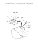 METHODS AND INSTRUMENTS FOR TREATING GERD AND HAITAL HERNIA diagram and image