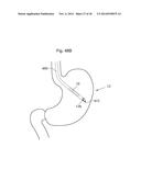 METHODS AND INSTRUMENTS FOR TREATING GERD AND HAITAL HERNIA diagram and image