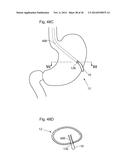 METHODS AND INSTRUMENTS FOR TREATING GERD AND HAITAL HERNIA diagram and image