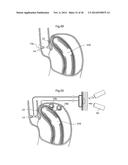 METHODS AND INSTRUMENTS FOR TREATING GERD AND HAITAL HERNIA diagram and image