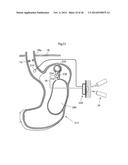 METHODS AND INSTRUMENTS FOR TREATING GERD AND HAITAL HERNIA diagram and image