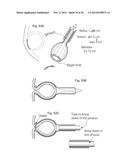 METHODS AND INSTRUMENTS FOR TREATING GERD AND HAITAL HERNIA diagram and image