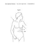 METHODS AND INSTRUMENTS FOR TREATING GERD AND HAITAL HERNIA diagram and image