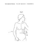 METHODS AND INSTRUMENTS FOR TREATING GERD AND HAITAL HERNIA diagram and image