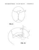 IMPLANTABLE SONIC WINDOWS diagram and image