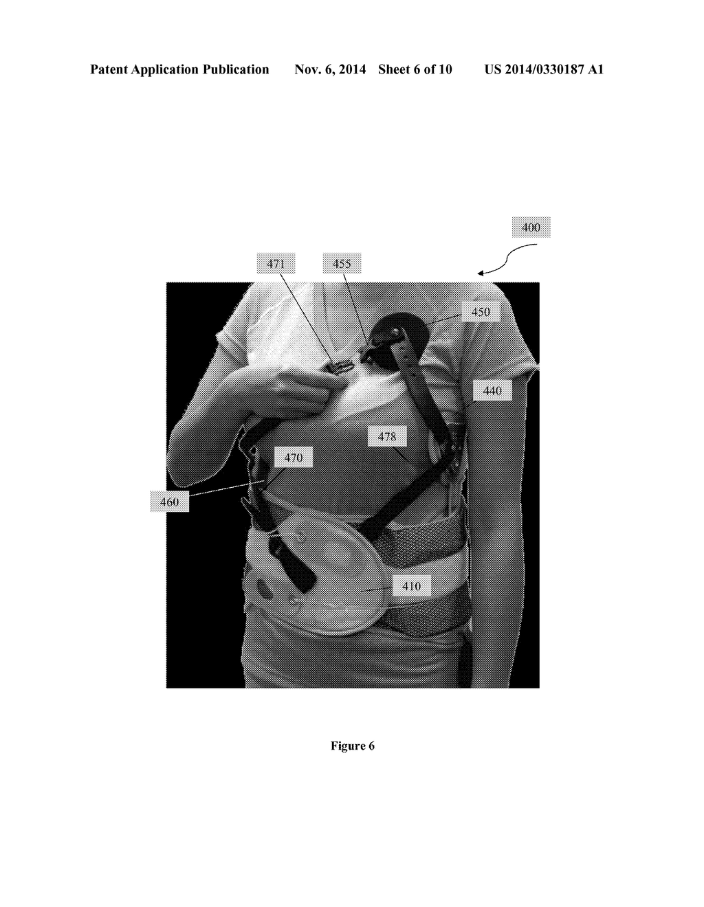 Scoliosis Brace - diagram, schematic, and image 07