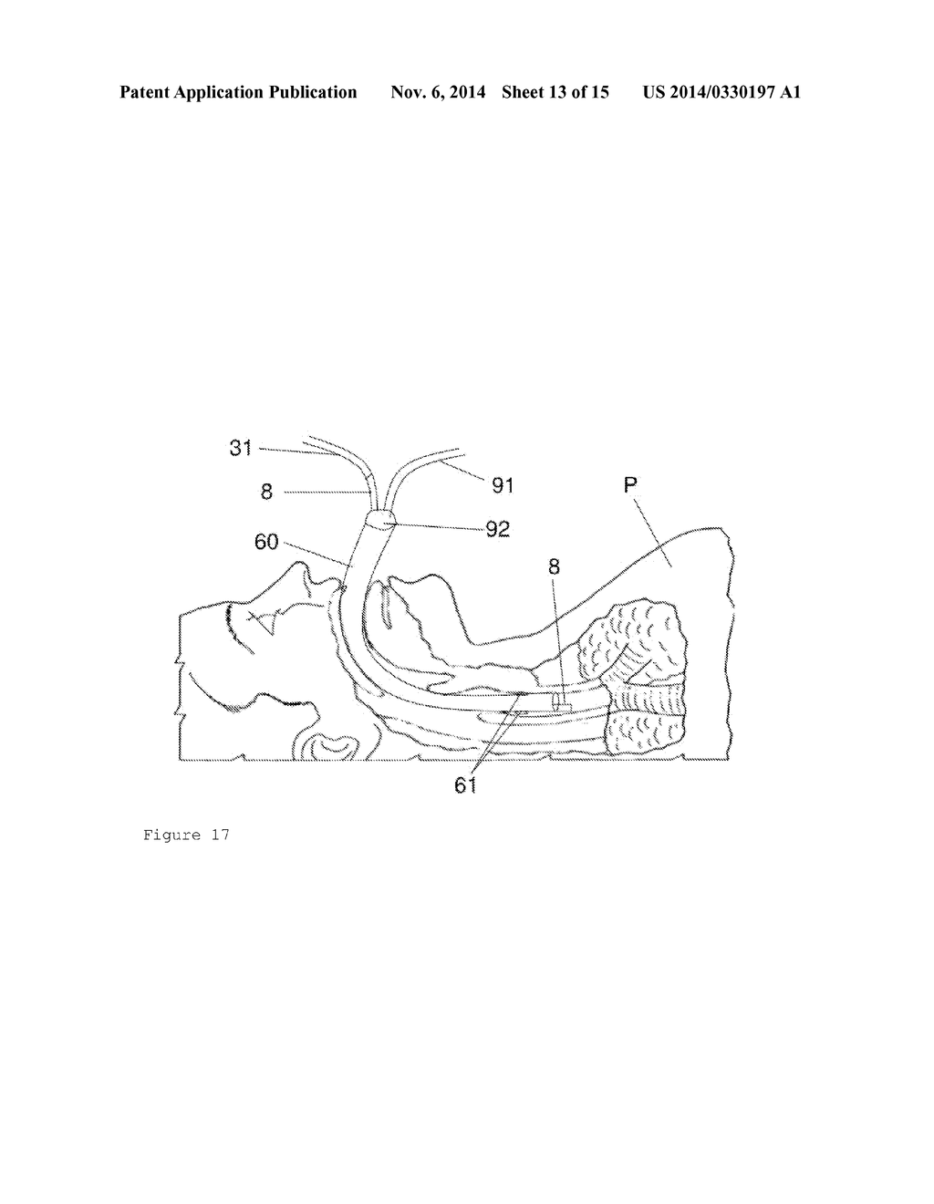 Device and Method for Cooling a Patient - diagram, schematic, and image 14