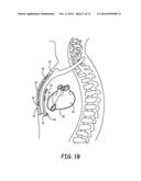 SYSTEMS AND METHODS FOR IMPLANTING A MEDICAL ELECTRICAL LEAD diagram and image