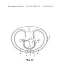 SYSTEMS AND METHODS FOR IMPLANTING A MEDICAL ELECTRICAL LEAD diagram and image