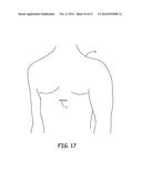 SYSTEMS AND METHODS FOR IMPLANTING A MEDICAL ELECTRICAL LEAD diagram and image