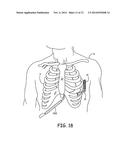 SYSTEMS AND METHODS FOR IMPLANTING A MEDICAL ELECTRICAL LEAD diagram and image