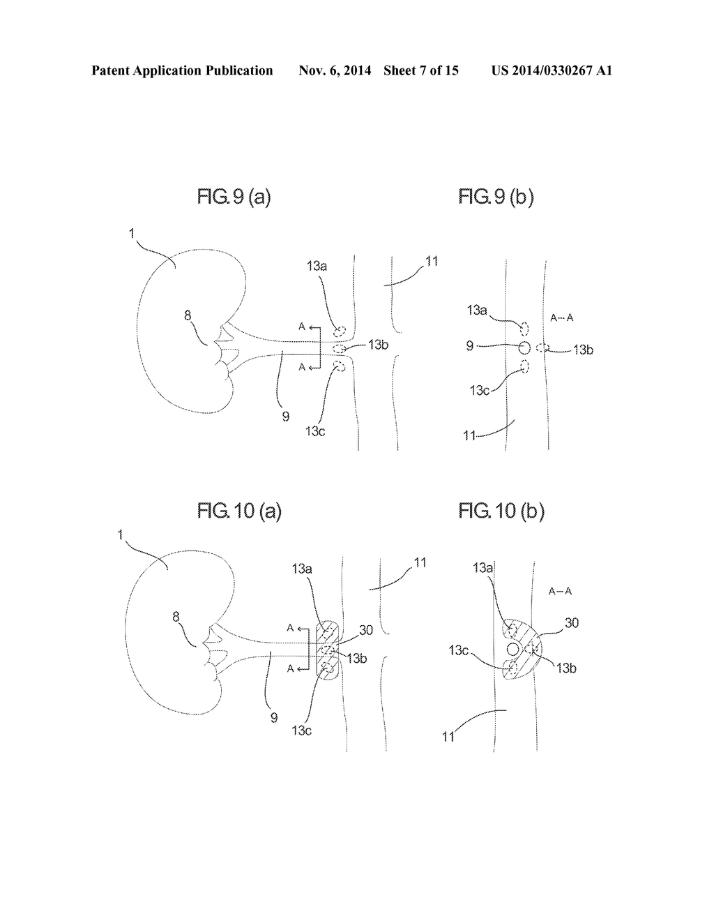 Devices And Methods For Detection And Treatment Of The Aorticorenal     Ganglion - diagram, schematic, and image 08