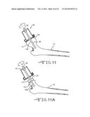 DISPOSABLE CYLINDRICAL CUTTER diagram and image