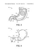 LOW VOLUME INTRAGASTRIC DEVICE diagram and image