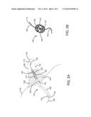 DEVICES AND SYSTEMS FOR INVERTING AND CLOSING THE LEFT ATRIAL APPENDAGE diagram and image