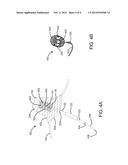 DEVICES AND SYSTEMS FOR INVERTING AND CLOSING THE LEFT ATRIAL APPENDAGE diagram and image